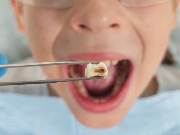 Best Emergency Wisdom Teeth Removal in Sturgeon, PA