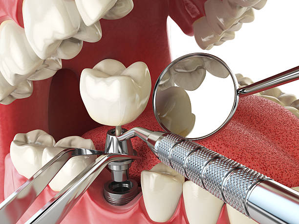 Best Emergency Tooth Extraction in Sturgeon, PA